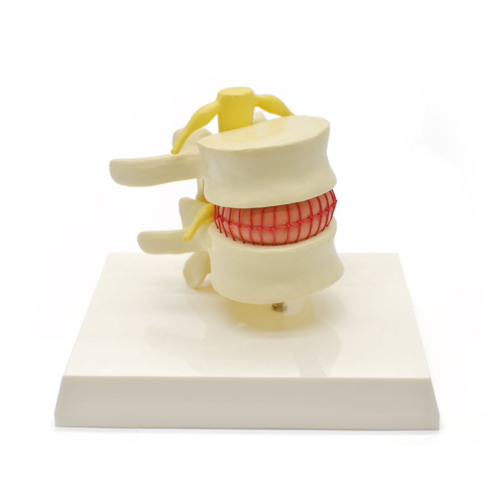 Modelo Demonstrativo de Hérnia de Disco Intervertebral